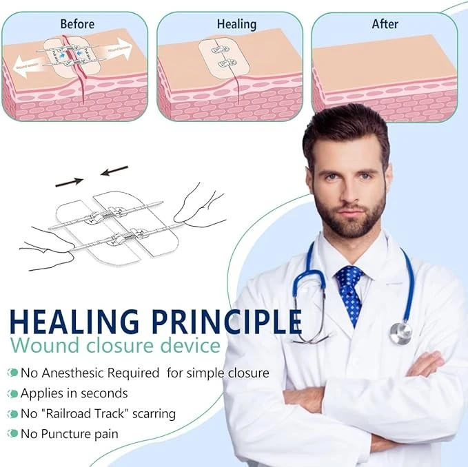 Wound Closure Skin Dressing Wound Closure Zipper Device Wound Closure Skin Dressing Wound Closure Zipper Device